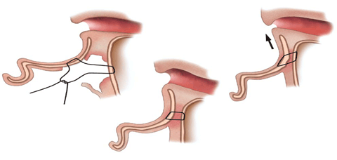 Otoplastia: Furnas