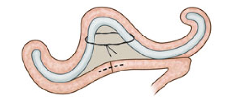 Otoplastia: Mustardé